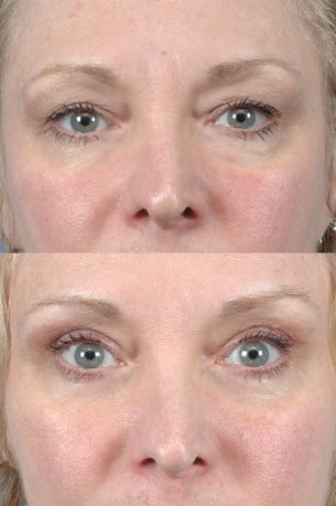 Upper Blepharoplasty | Eyes | Photos: Before and After Treatments - Female patient (frontal view)
