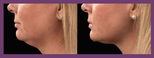 female patient before and after Coolsculpting for the Chin