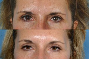 EYES: Botox Cosmetic - Photo Before and After Treatment Female (frontal view)