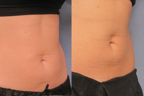 Cool Sculpting - photos before and after