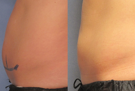 photos before and after Cool Sculpting