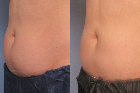 Cool Sculpting - pics patient before and after