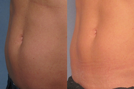 pics patient before and after Cool Sculpting