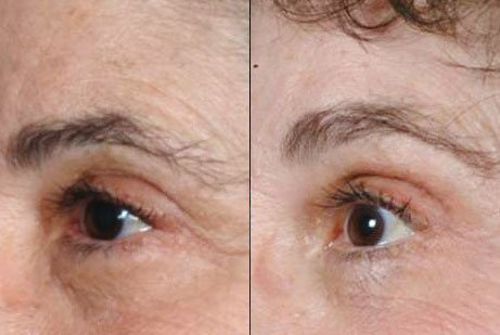 photos eyes patient before and after Botox