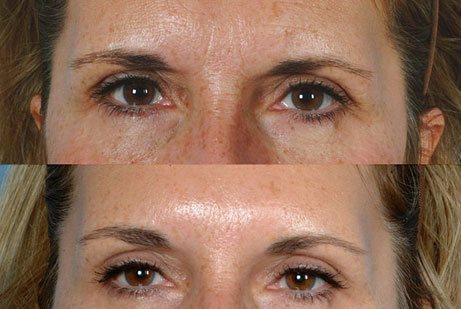 photos eyes before and after Botox
