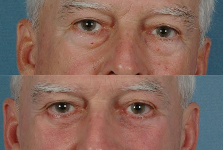 photos eyes before and after Lower Blepharoplasty