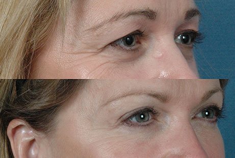 photos eyes before and after Upper and Lower Blepharoplasty