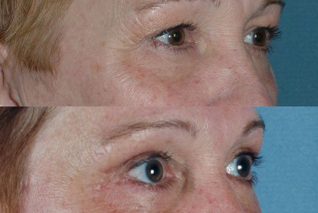 photos eyes before and after Upper Blepharoplasty