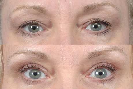 before and after Upper Blepharoplasty - photos eyes