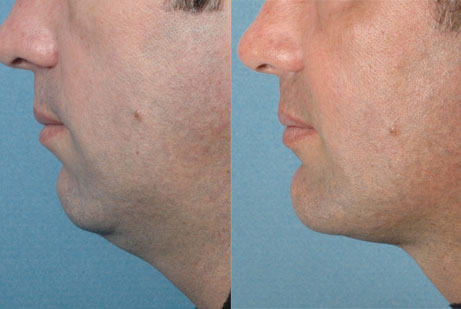 Chin Implant - photos before and after
