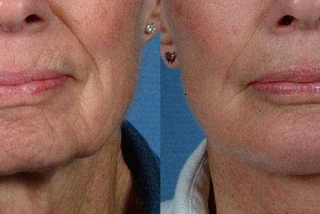Facelift - pics patient before and after