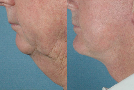 pics patient before and after Facelift