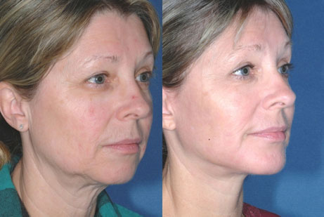 photos before and after Facelift procedures