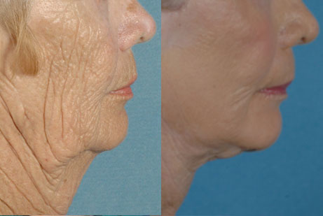 images before and after Facelift procedures