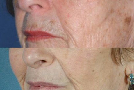 photos eyes patient before and after Upper Blepharoplasty