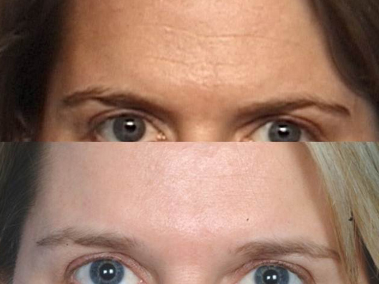 photos patient before and after Forehead and Brows