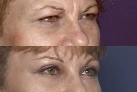 photos eyes before and after Upper and Lower Blepharoplasty