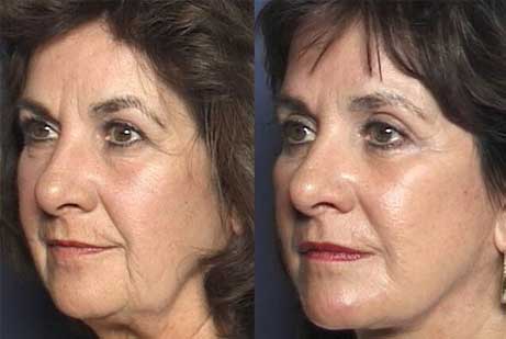 before and after Upper Blepharoplasty - photos eyes