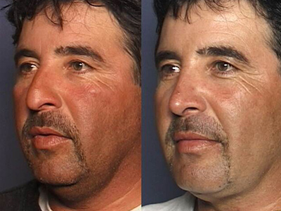 photos patient before and after Nose