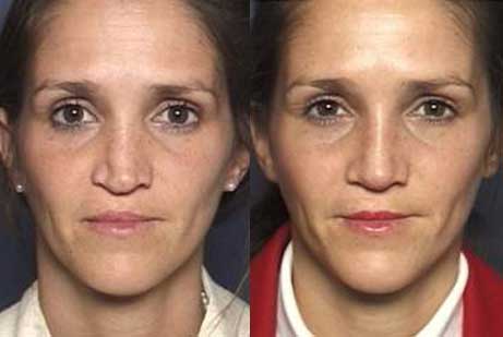 photos eyes patient before and after Upper Blepharoplasty