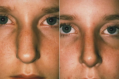 NOSE |Rhinoplasty| Before and After treatment