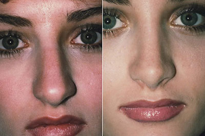 Gallery: Nose - Septorhinoplasty - Before and After Treatment Photos: Woman (left side, oblique view)