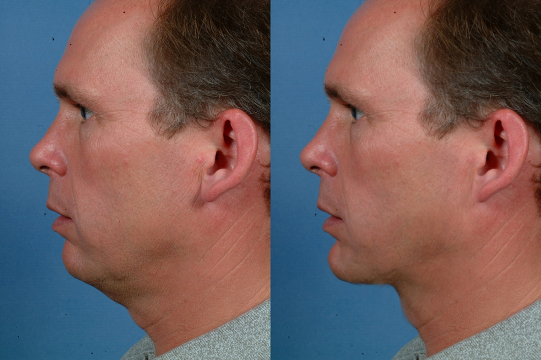 Gallery: Lower Face - Before and After