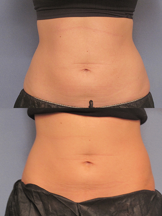 Gallery: Cool Sculpting - Before and After
