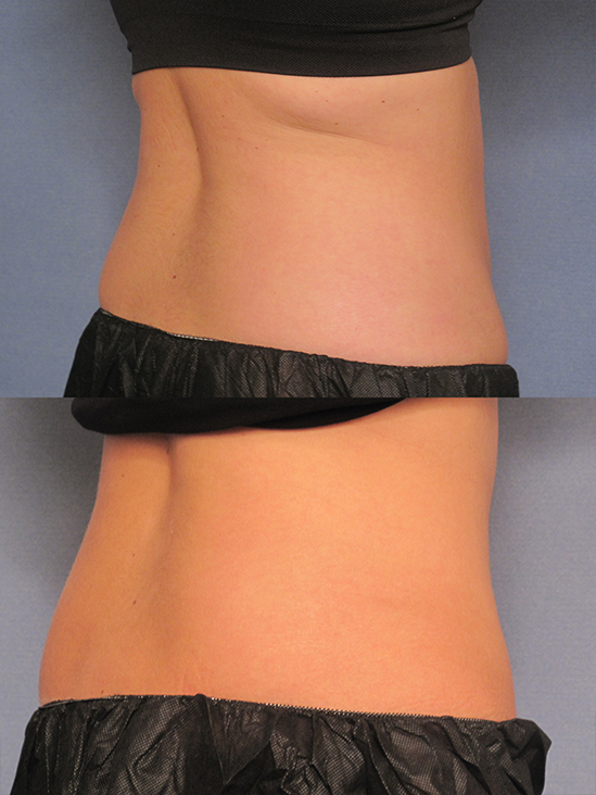 pics before and after CoolSculpting