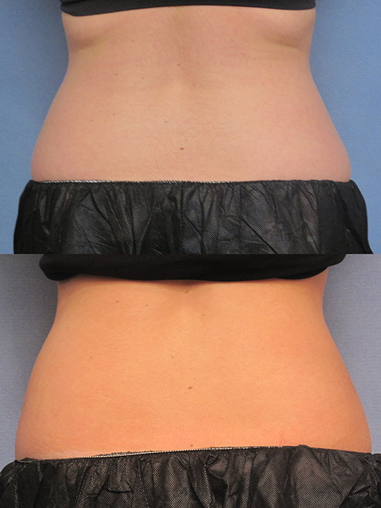images patient before and after CoolSculpting