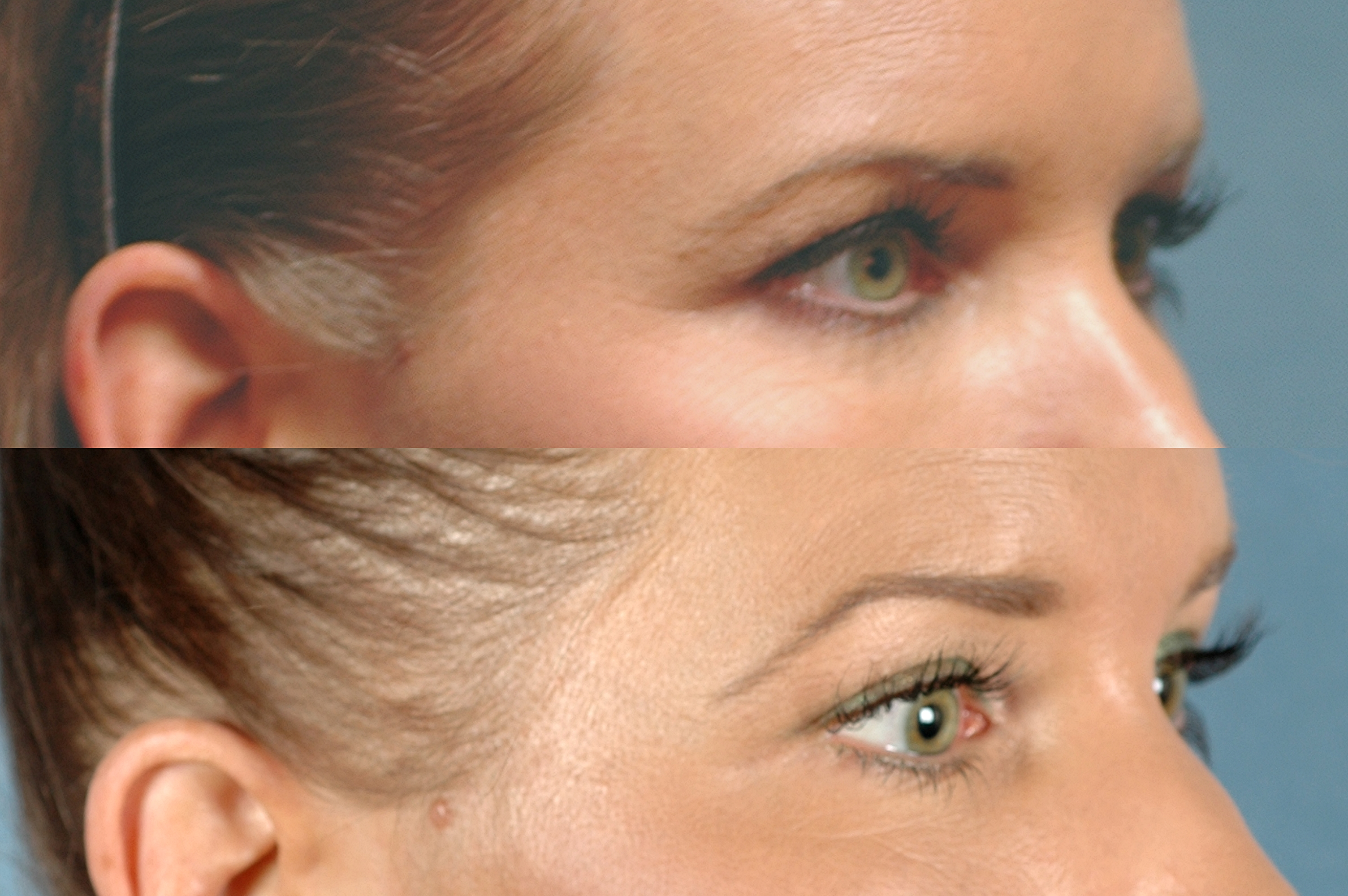 EYES GALLERY: Before and After Photos: Ultherapy - Female patient (right side, oblique view)