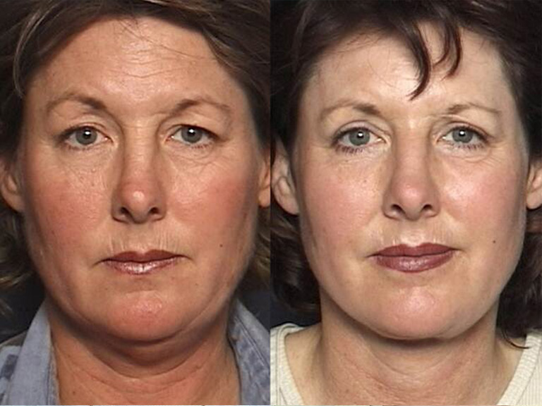 images patient before and after Full Face Rejuvenation