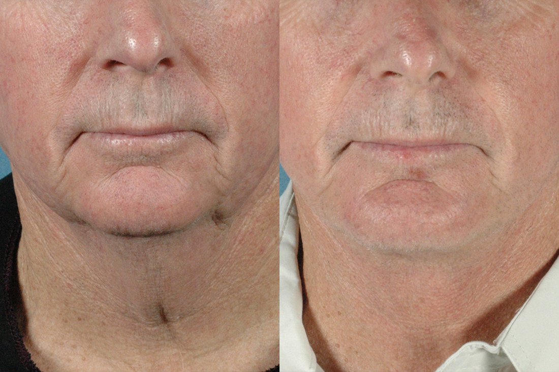 LOWER FACE: Chin implant with rhinoplasty - Before and After Photos: Female