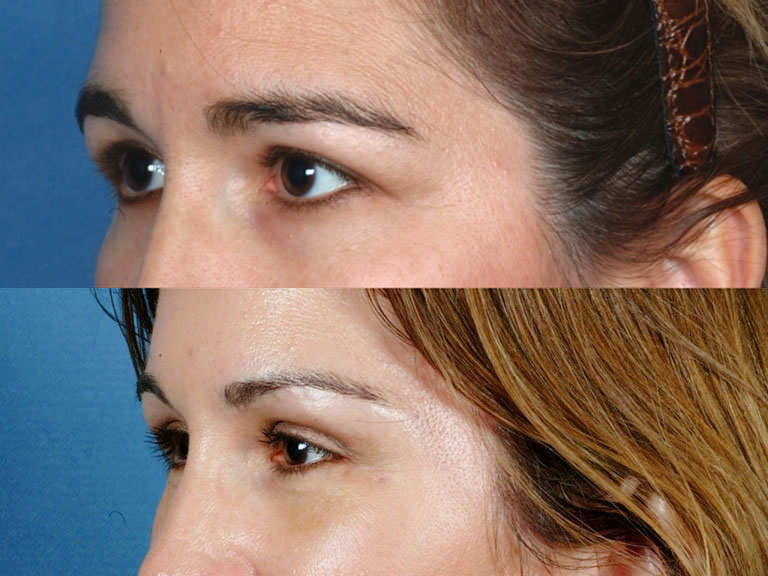 FOREHEAD AND BROWS: Before and After Treatment Photos: Woman patient (left side, oblique view)
