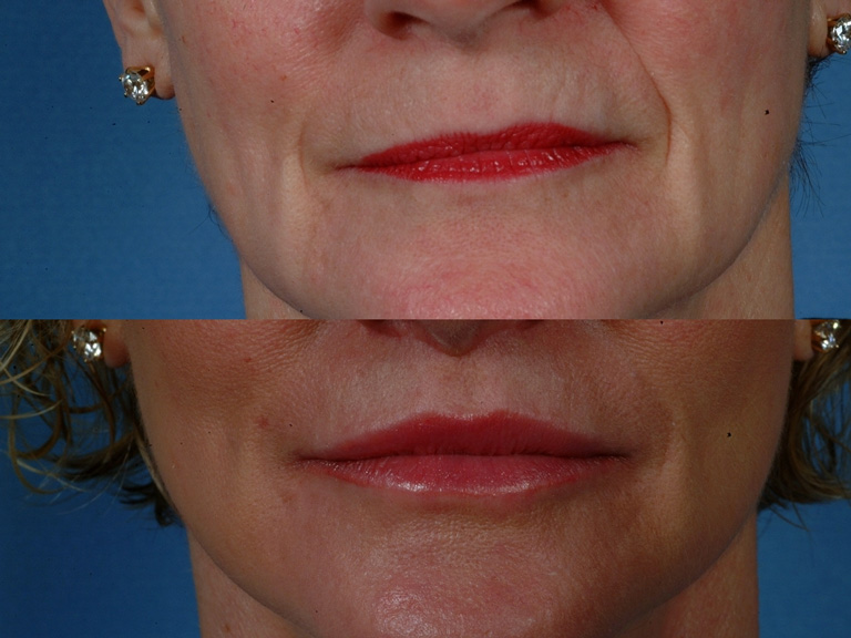 MOUTH AND LIPS | Photos: Before and After Treatment - female (frontal view)
