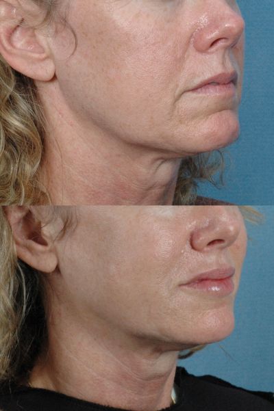 Featured Gallery: Non-Surgical Facial Rejuvenatio|Before and After Photos| Female patient (right side, oblique view)