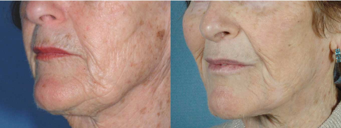 pics before and after Perioral Laser Resurfacing