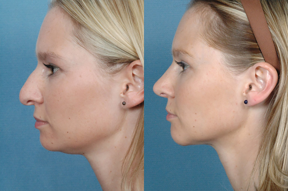 Before and After Treatment Photo - Nose (female, left side view)