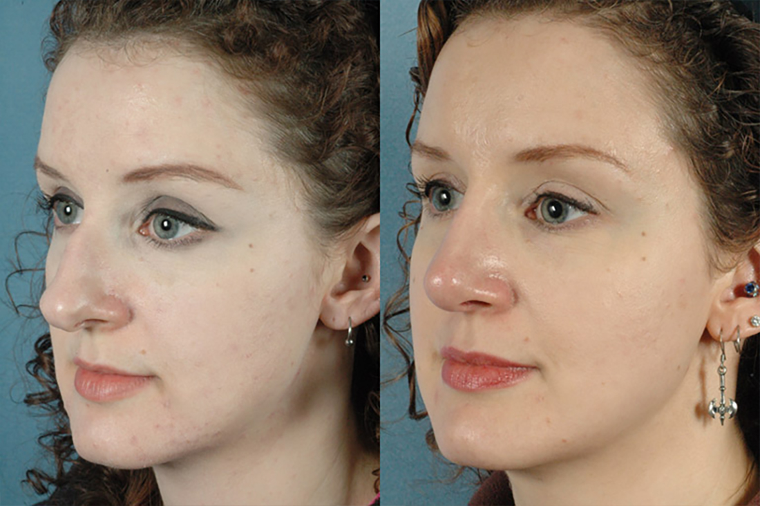 Gallery: Nose - Septorhinoplasty - Before and After Treatment Photos: Female patient (left side, oblique view)