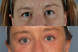 Gallery: Eyes - Before and After