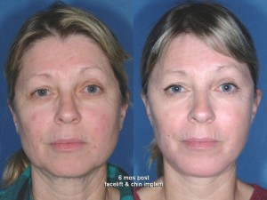 pics female patient before and after Chin Implants - front view