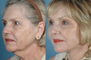 Featured Gallery: Full Face Surgical Rejuvenation|Before and After Photos| Female patient (right side, oblique view)