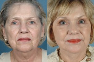 Featured Gallery: Full Face Surgical Rejuvenation|Before and After Photos| Female (frontal view)