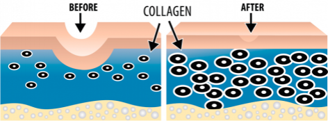 Micro-Needling - collagen induction therapy