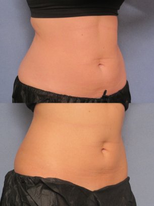 images before and after CoolSculpting