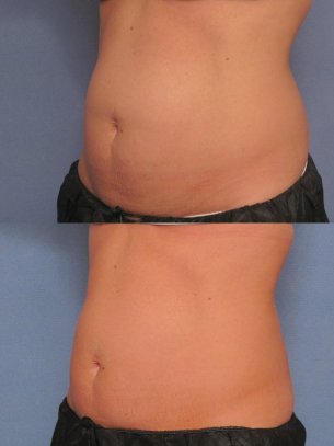before and after CoolSculpting procedures - photos