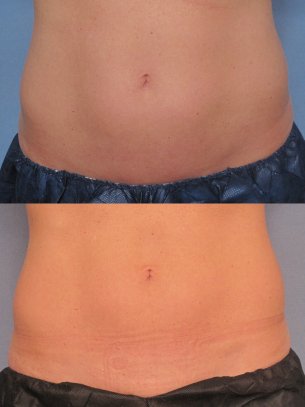 photos abdominal area before and after CoolSculpting