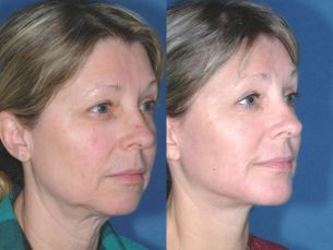 LOWER FACE - Facelift - Before and After 6 mounth - Photos: Female patient (right side, oblique view)
