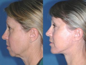 LOWER FACE - Facelift - Before and After 6 mounth - Photos: Female patient (left side view)