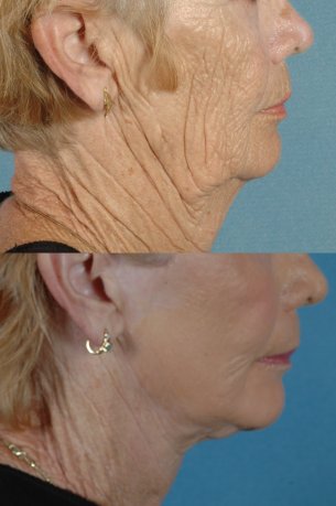 LOWER FACE | Facelift | Before and After Treatment Photos: Female (right side view)